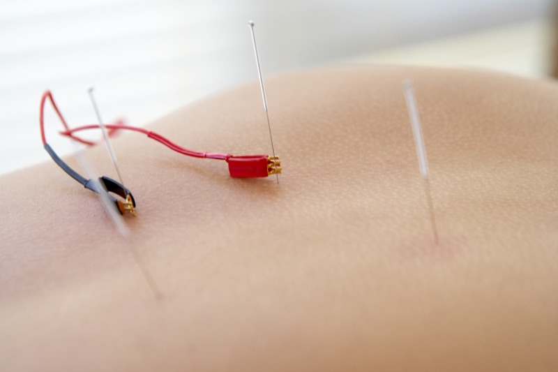 Electro-Acupuncture